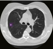 🩻 Time to Diagnosis: Predictive Modeling for Lung Cancer Screening